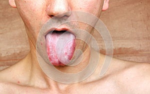 Infection tongue