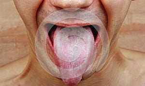 Infection tongue