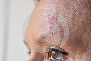 Infection by varicella herpes zoster on the face photo