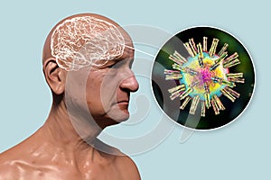 Infectious etiology of dementia