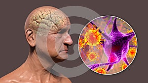 Infectious etiology of dementia