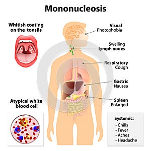 Infectious mononucleosis