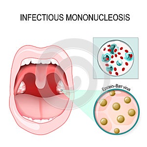 Infectious mononucleosis