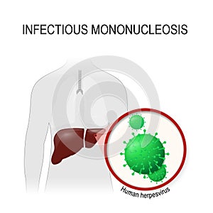 Infectious mononucleosis. Human herpevirus photo