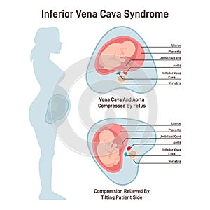 Inferior vena cava syndrome. Pregnant woman has a compression