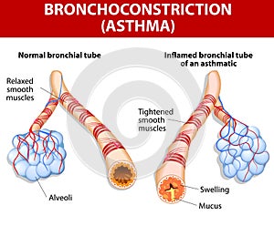 Inflamation of the bronchus causing asthma