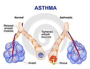 Inflamation of the bronchus causing asthma photo