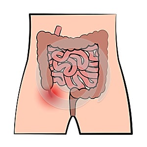 Inflamed Appendix Appendicitis Digestive System photo