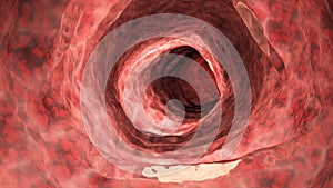 An inflamed colon