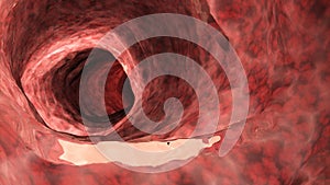An inflamed colon photo