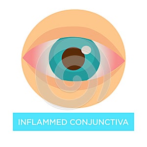 Inflamed conjunctiva conjuntivitis sore eye medicine and health photo