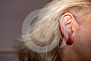 Inflamed earlobe after ear piercing