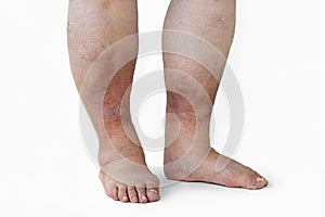 Inflamed legs of a woman with diabetes, close-up