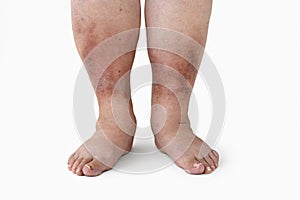 Inflamed legs of a woman with diabetes, close-up