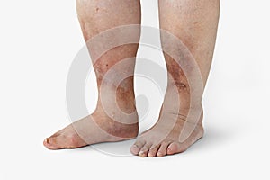 Inflamed legs of a woman with diabetes, close-up