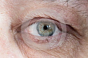 Inflamed male eye with chalazion on eyelid photo
