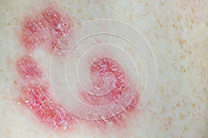 Inflamed psoriatic plaques on white skin. Macro photography photo