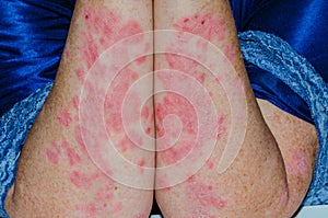 Inflamed psoriatic plaques on the white skin of the woman`s forearms