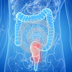 An inflamed rectum