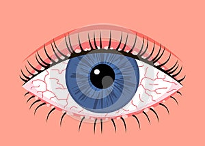 Inflamed sick human eye with blepharitis, allergy symptom red veins. Eye disease, fatigue or allergic conjunctivitis