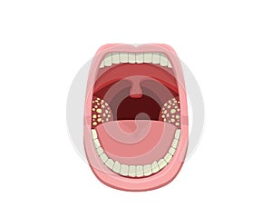 Inflamed Tonsillitis in vector design