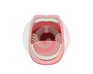 Inflamed Tonsillitis in vector design photo