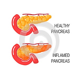 Inflames pancreas concept. Vector illustration