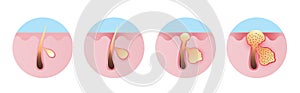 Inflammation acne process vector icon set illustration on white background.