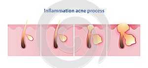 Inflammation acne process vector illustration isolated on white background.