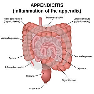 Inflammation of the appendix photo