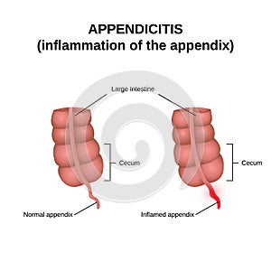 Inflammation of the appendix photo