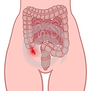 Inflammation of the appendix photo