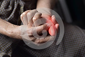 Inflammation of Asian man thumb. Concept of painful digit, cellulitis or finger problems photo