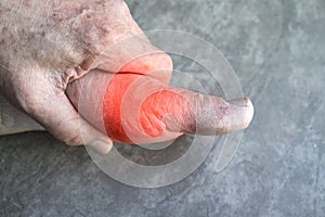 Inflammation of Asian manâ€™s foot. Concept of foot joint pain, stumble, arthritis, hyperuricema or gout