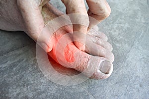 Inflammation of Asian manâ€™s foot. Concept of foot joint pain, stumble, arthritis, hyperuricema or gout