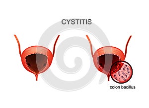 Inflammation of the bladder caused by E. coli