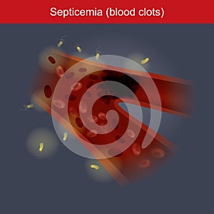 Septicemia. Info graphic. photo