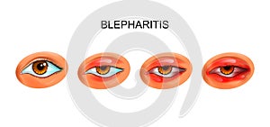 Inflammation of the eyelids. blepharitis