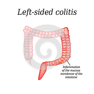 Inflammation of the large intestine divisions. Vector illustration on background photo