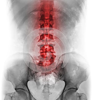 Inflammation of lumbosacral spine . Concept of vertebral care