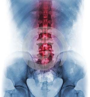 Inflammation of lumbosacral spine . Concept of vertebral care photo