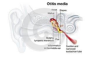 Inflammation of the middle ear, otitis media, medically illustration