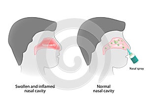 Inflammation of the nasal cavity and nasal cavity healthy photo