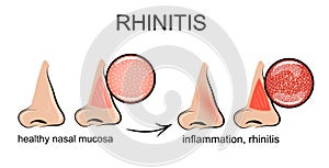 Inflamación de 