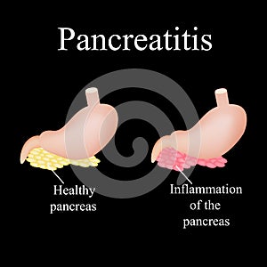 Inflammation of the pancreas. Pancreatitis. The