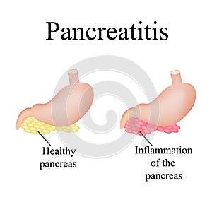 Inflammation of the pancreas. Pancreatitis. Vector