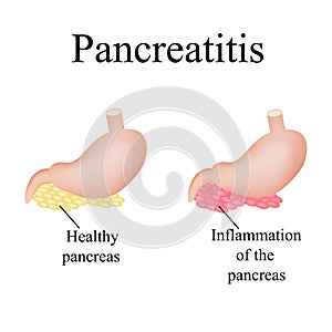 Inflammation of the pancreas. Pancreatitis. Vector photo