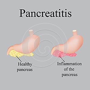 Inflammation of the pancreas. Pancreatitis. Vector illustration on a gray background