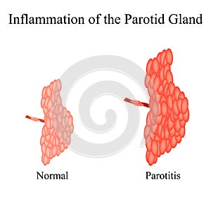 Inflammation of the parotid gland.The structure of the parotid salivary gland. Vector illustration on isolated photo