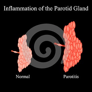 Inflammation of the parotid gland.The structure of the parotid salivary gland. Vector illustration on isolated photo